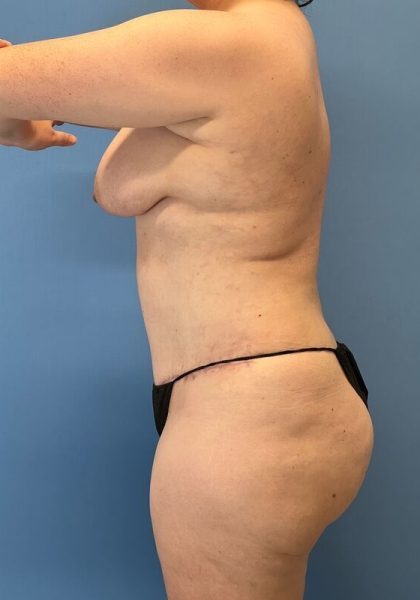 Tummy Tuck Before & After Image