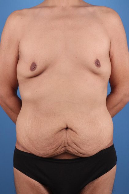 Tummy Tuck Before & After Image