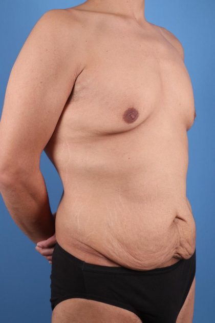 Tummy Tuck Before & After Image