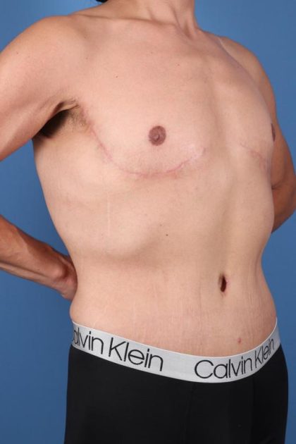 Tummy Tuck Before & After Image