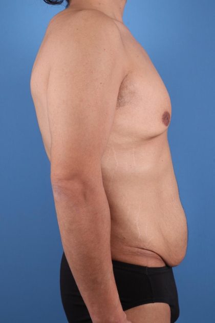 Tummy Tuck Before & After Image