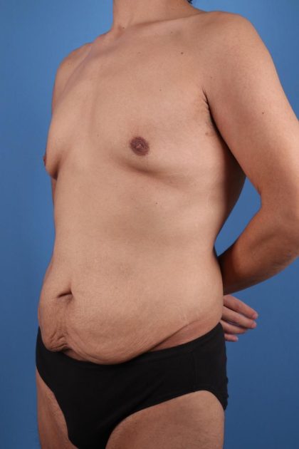 Tummy Tuck Before & After Image