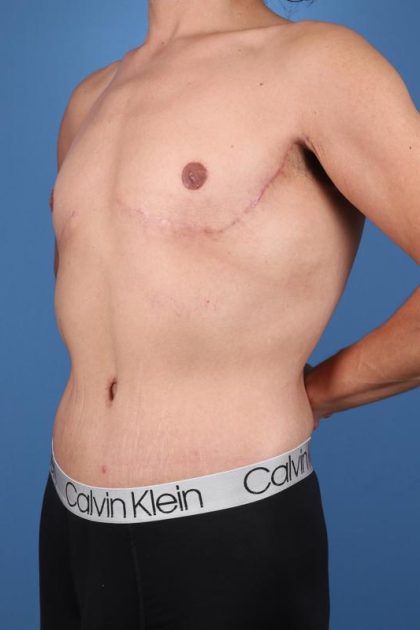 Tummy Tuck Before & After Image