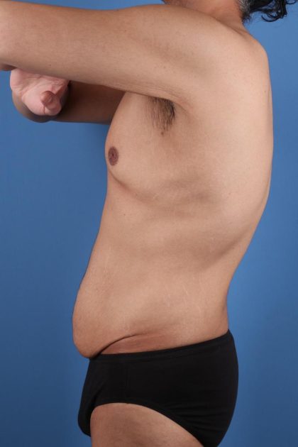 Tummy Tuck Before & After Image