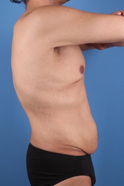 Tummy Tuck Before & After Image