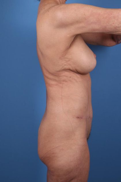 Tummy Tuck Before & After Image