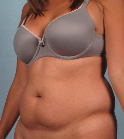 Vaser Liposuction Before & After Image