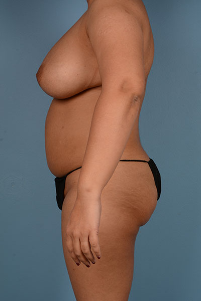 Vaser Liposuction Before & After Image