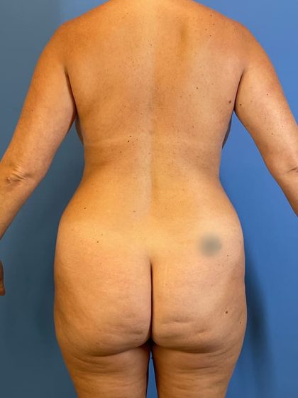 Vaser Liposuction Before & After Image