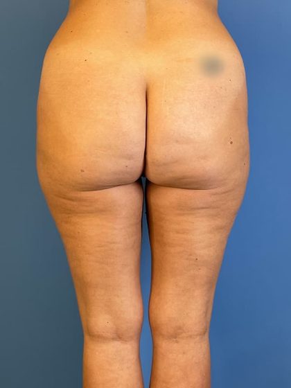 Vaser Liposuction Before & After Image