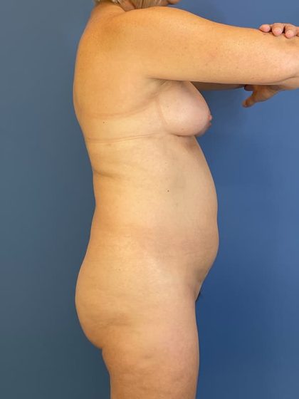 Vaser Liposuction Before & After Image