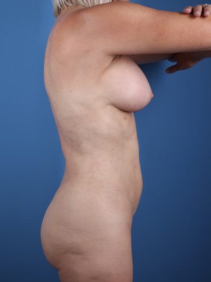 Vaser Liposuction Before & After Image