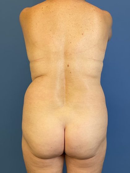 Vaser Liposuction Before & After Image