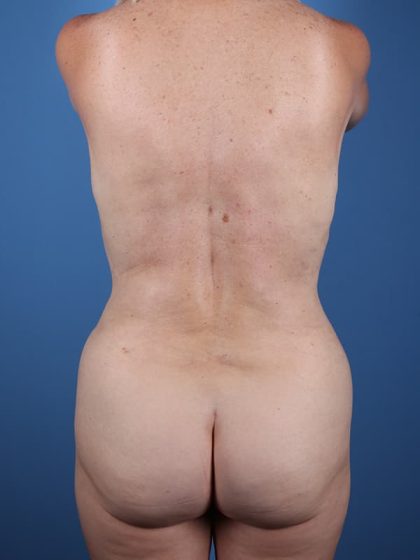 Vaser Liposuction Before & After Image