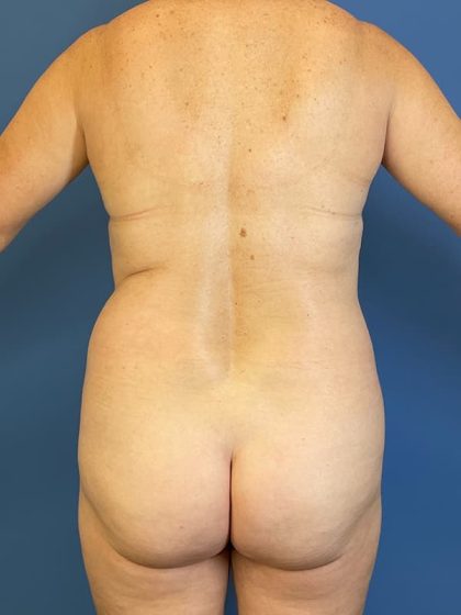 Vaser Liposuction Before & After Image