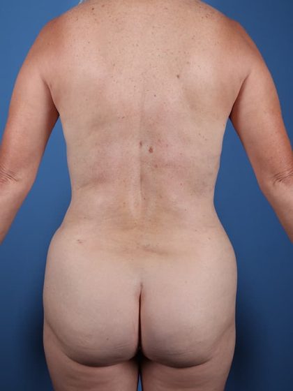 Vaser Liposuction Before & After Image