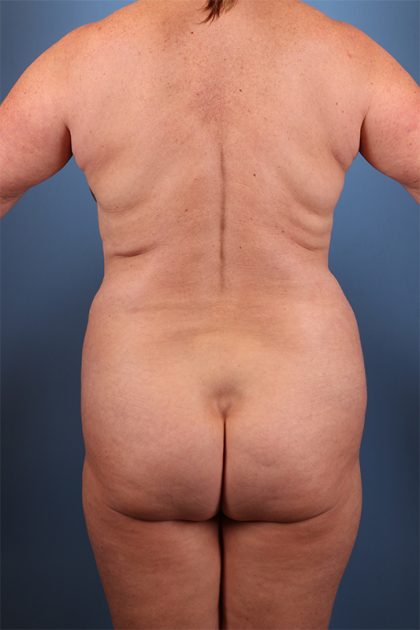 Vaser Liposuction Before & After Image