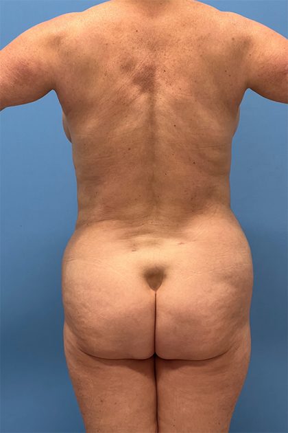 Vaser Liposuction Before & After Image