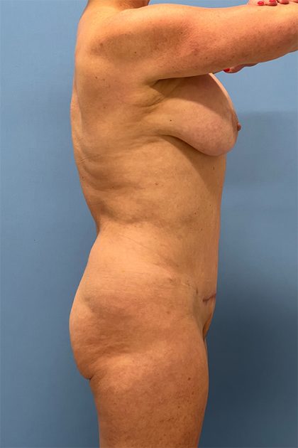 Vaser Liposuction Before & After Image