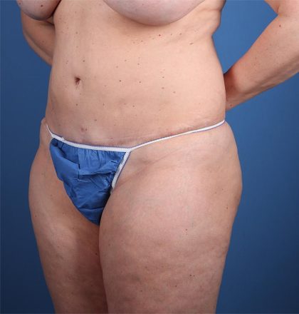 Vaser Liposuction Before & After Image