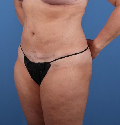 Vaser Liposuction Before & After Image