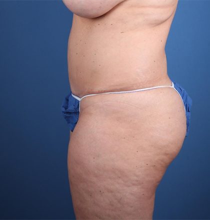 Vaser Liposuction Before & After Image