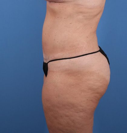 Vaser Liposuction Before & After Image