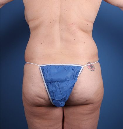 Vaser Liposuction Before & After Image