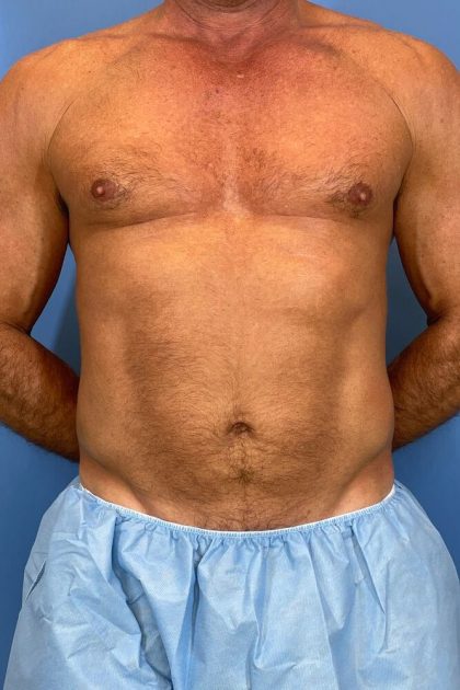 Vaser Liposuction Before & After Image