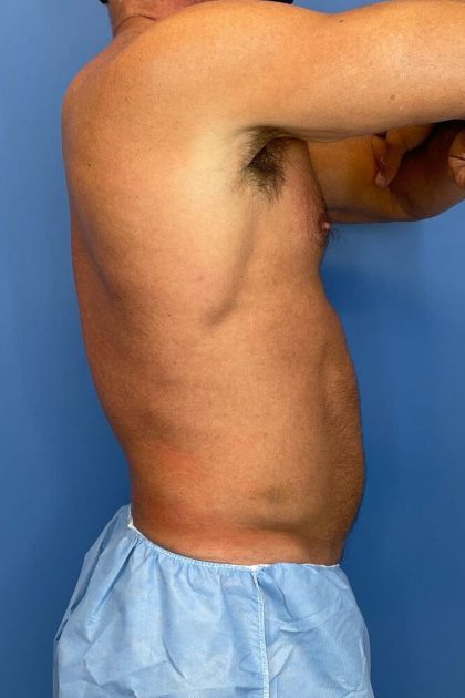 Vaser Liposuction Before & After Image