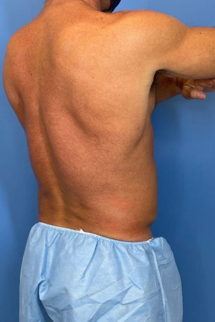 Vaser Liposuction Before & After Image