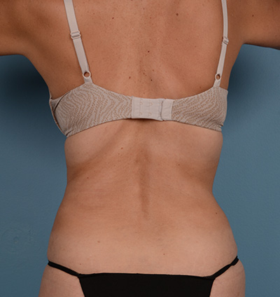 Vaser Liposuction Before & After Image