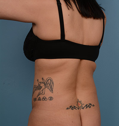 Vaser Liposuction Before & After Image