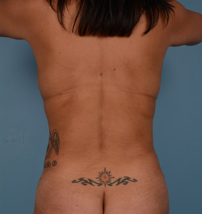 Vaser Liposuction Before & After Image