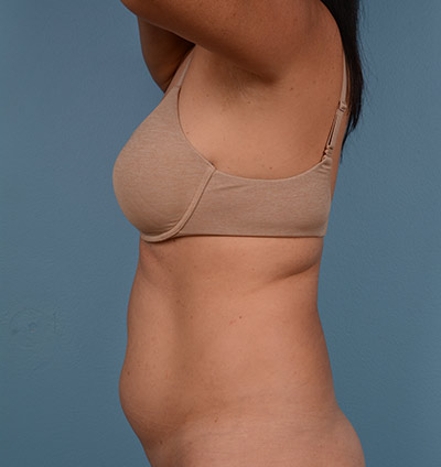 Vaser Liposuction Before & After Image