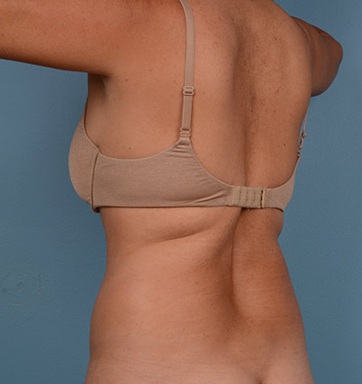 Vaser Liposuction Before & After Image