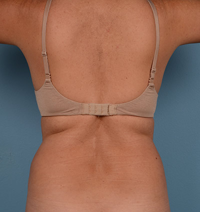 Vaser Liposuction Before & After Image