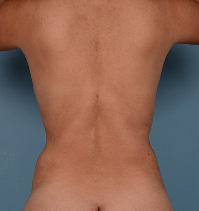 Vaser Liposuction Before & After Image