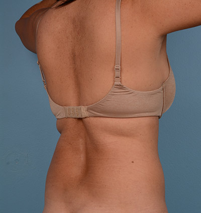 Vaser Liposuction Before & After Image