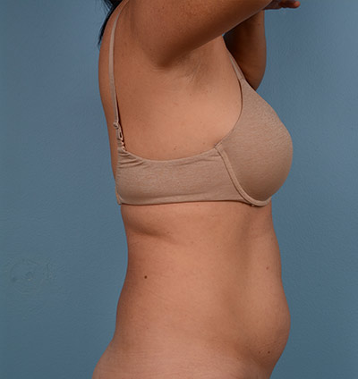 Vaser Liposuction Before & After Image