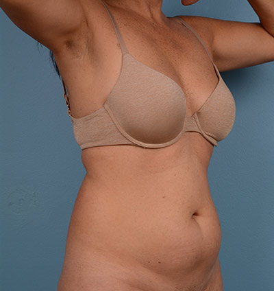 Vaser Liposuction Before & After Image