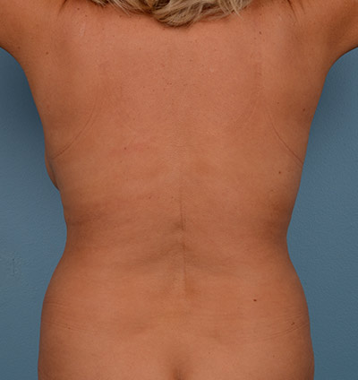 Vaser Liposuction Before & After Image