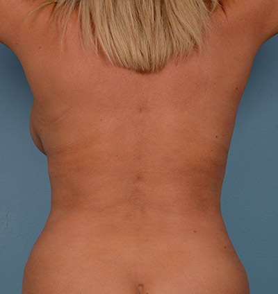 Vaser Liposuction Before & After Image