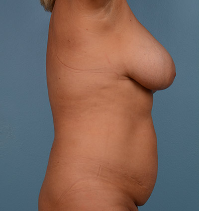 Vaser Liposuction Before & After Image