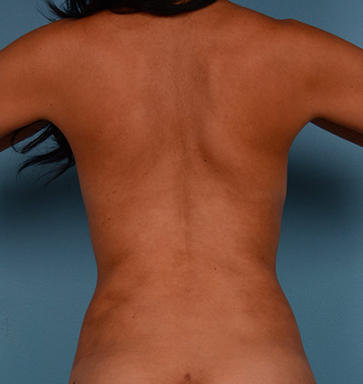 Vaser Liposuction Before & After Image