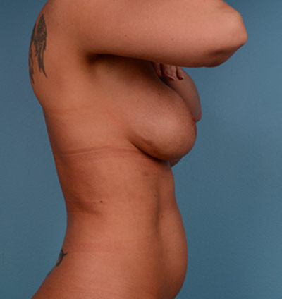 Vaser Liposuction Before & After Image