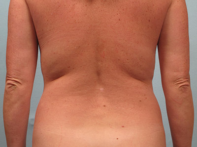 Vaser Liposuction Before & After Image