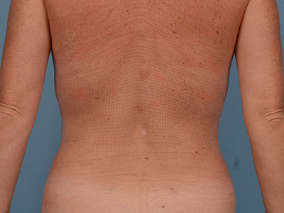 Vaser Liposuction Before & After Image