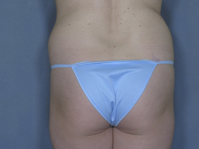 Vaser Liposuction Before & After Image