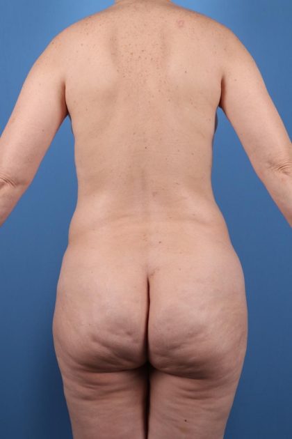 Vaser Liposuction Before & After Image